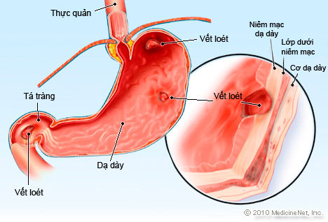 Biến chứng nguy hiểm của bệnh viêm loét dạ dày