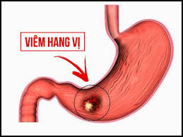 Những sai lầm khiến bệnh viêm hang vị dạ dày khó có thể điều trị khỏi