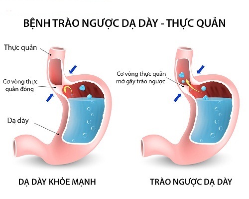 Bệnh trào ngược dạ dày nên kiêng gì?