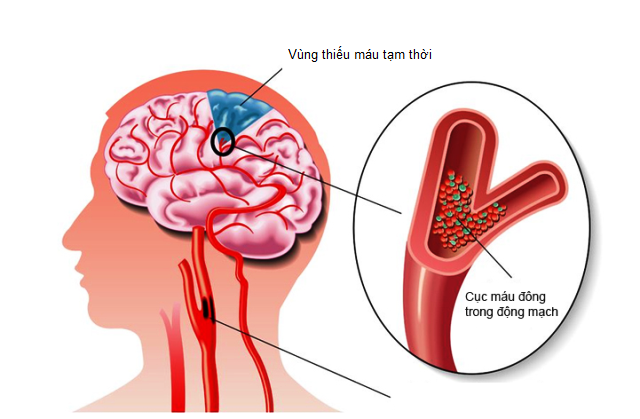 Những nguyên nhân thiếu máu não theo từng độ tuổi