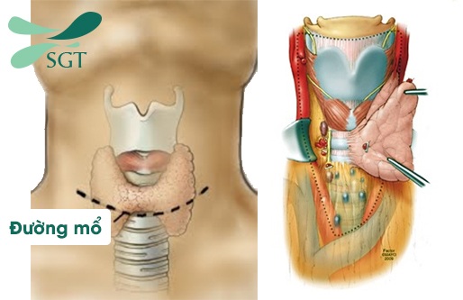 Những biến chứng thường gặp sau phẫu thuật tuyến giáp