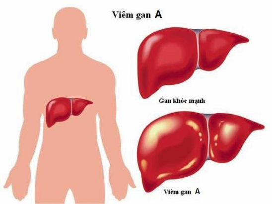 Cách phòng bệnh và điều trị khi bị viêm gan siêu vi A