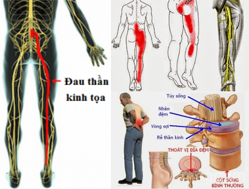 Đau thần kinh tọa là gì?