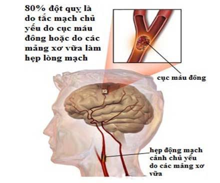 Tai biến mạch máu não là gì?