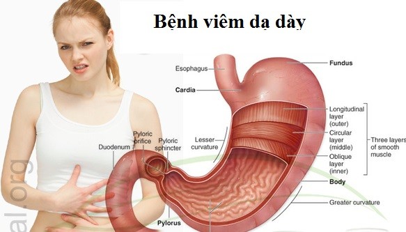 Bệnh viêm dạ dày là gì?