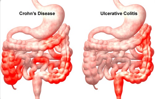 Những hiểu biết căn bản về bệnh viêm ruột mãn tính