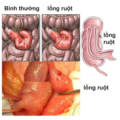 Bệnh lồng ruột là gì?