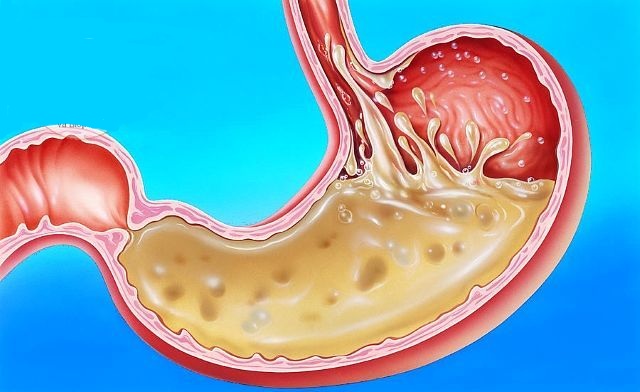 Bệnh trào ngược dạ dày thực quản là gì?