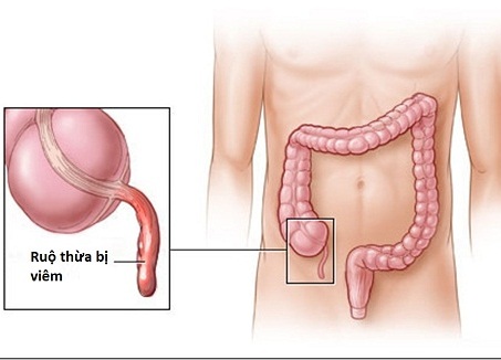 Viêm ruột thừa là gì?