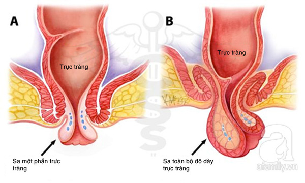 Tổng quan sa trực tràng