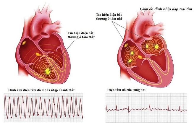 Tổng quan về rối loạn nhịp tim