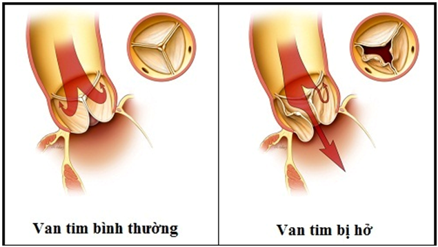 Sơ lược về bệnh van tim