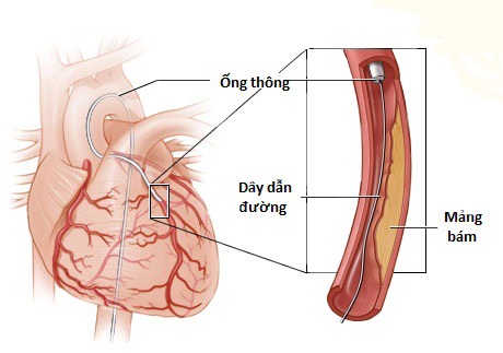 Bệnh mạch vành hay bệnh tim thiếu máu cục bộ là gì?