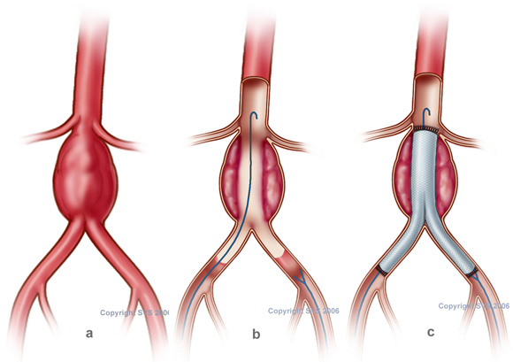 Bệnh phình động mạch chủ