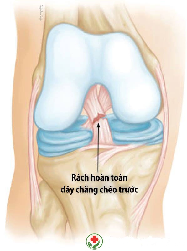 Rách dây chằng trước khớp gối là gì?