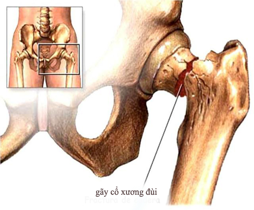 Vô mạch hoại tử là gì?