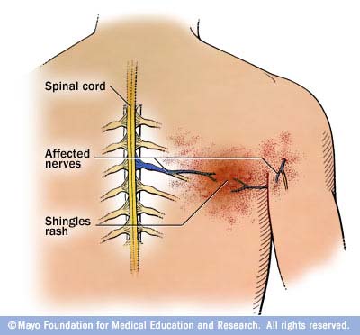 Đau dây thần kinh sau herpes (Postherpetic) là gì?