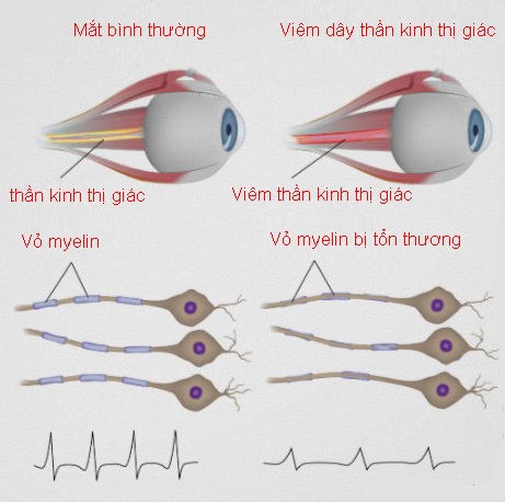Viêm dây thần kinh thị giác là gì?