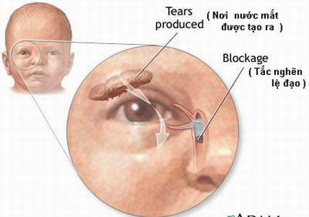 Tắc tuyến lệ là gì?