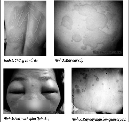 Phát ban và phù mạch, mày đay và phù quincke, đỏ, sưng, ngứa da