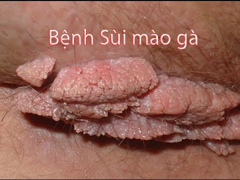 Sùi mào gà là gì?