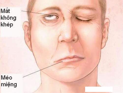 Chứng liệt nửa mặt là gì?