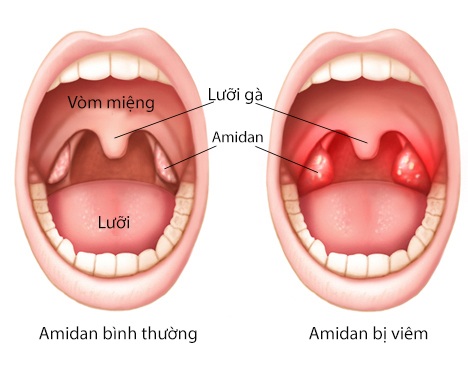 Viêm amidan là gì?