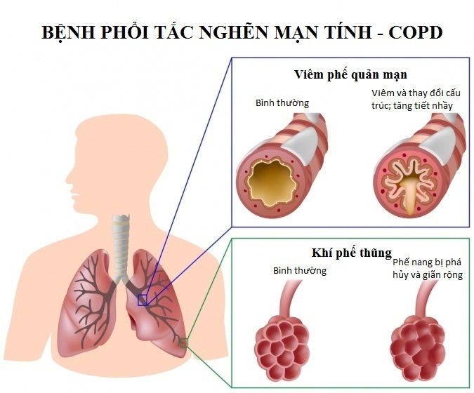 Nghẽn tắc phổi mạn tính là bệnh gì?