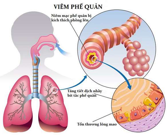 Thế nào là viêm phế quản?