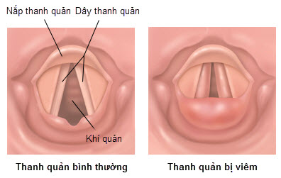 Viêm thanh quản, bệnh gây đau họng, mất giọng