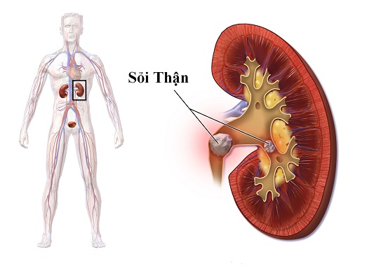 Hiểu biết về bệnh sỏi thận