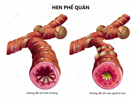 Hen phế quản là gì? Phương pháp điều trị