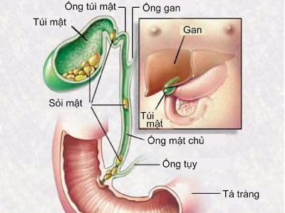 Thế nào là bệnh sỏi mật?