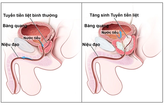 Viêm tuyến tiền liệt là gì?