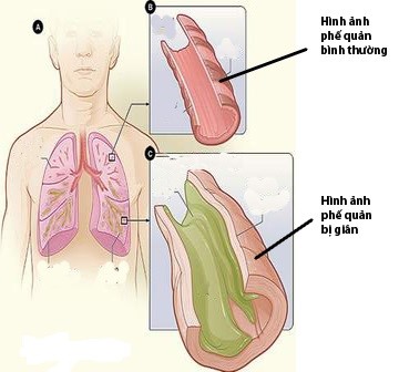 Tìm hiểu về giãn phế quản