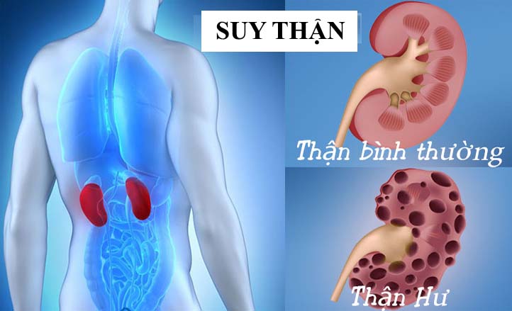 Thế nào là suy thận mãn tính?