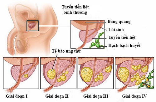 Ung thư tuyến tiền liệt là gì?