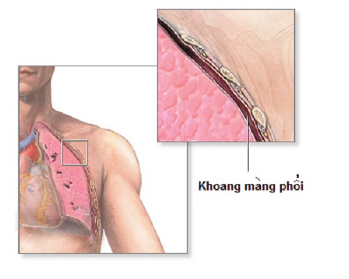 Tìm hiểu về bệnh viêm màng phổi