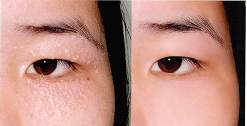 Trị mụn thịt cứng đầu chỉ bằng 1 tép tỏi tươi trong 1 tuần