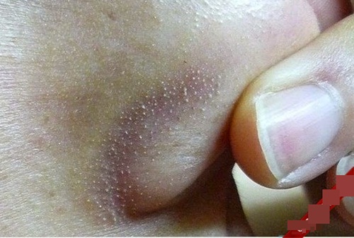 Loại bỏ mụn cám xấu xí chỉ với 1 nhánh nha đam
