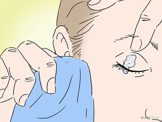 Phương pháp tẩy keo 502 dính vào cơ thể nhanh mà an toàn