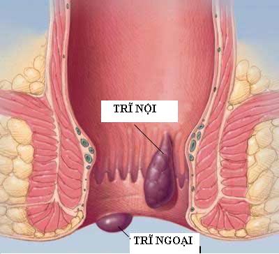 Chữa bệnh trĩ bằng lá thiên lý, rau diếp cá và lá bỏng