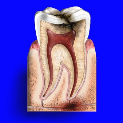 Những cách giúp giảm đau răng hay đau tủy răng