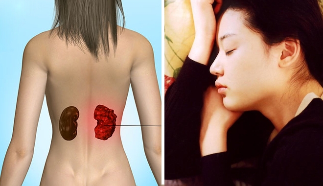 5 dấu hiệu cho biết bạn bị ung thư thận 5 dấu hiệu cho biết bạn bị ung thư thận