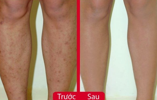 Sẹo thâm lâu năm ở chân tay do muỗi đốt hay tai nạn cũng sẽ mờ ngay tức khắc nhờ hành tím