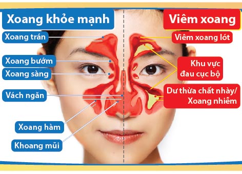 Ăn uống những gì để giảm bệnh viêm xoang