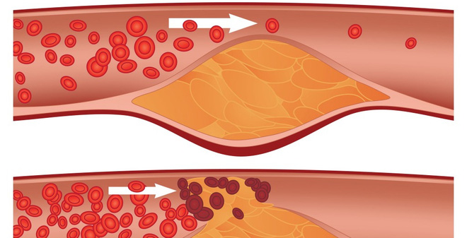 6 thực phẩm dành riêng cho người sợ bệnh tắc nghẽn mạch máu