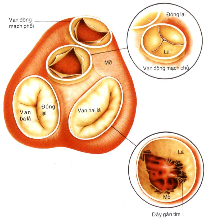 Bệnh van tim