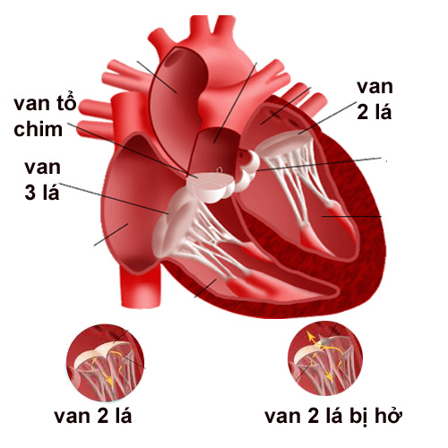 Phòng ngừa bệnh hở van tim