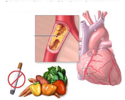 Bệnh động mạch vành nguy hiểm như thế nào?